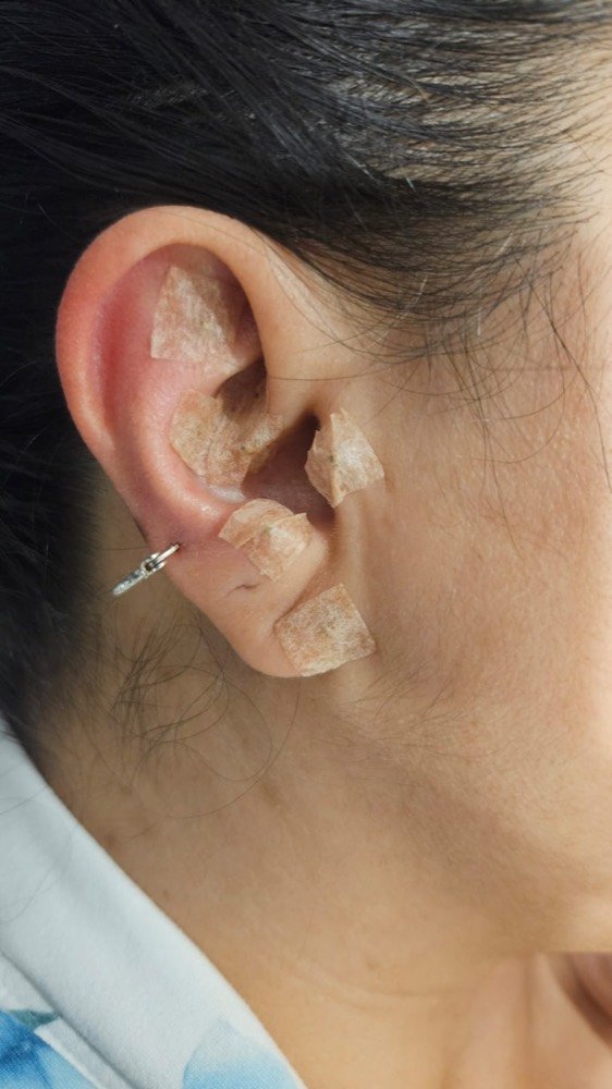 Auriculoterapia: puntos reflejos en el pabellón auricular